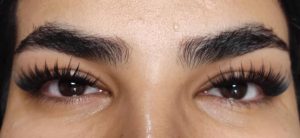 کاشت مژه هیدن (نامرئی)